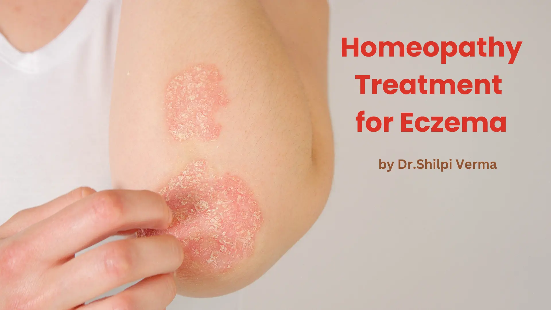 Homeopathy Treatment for Eczema